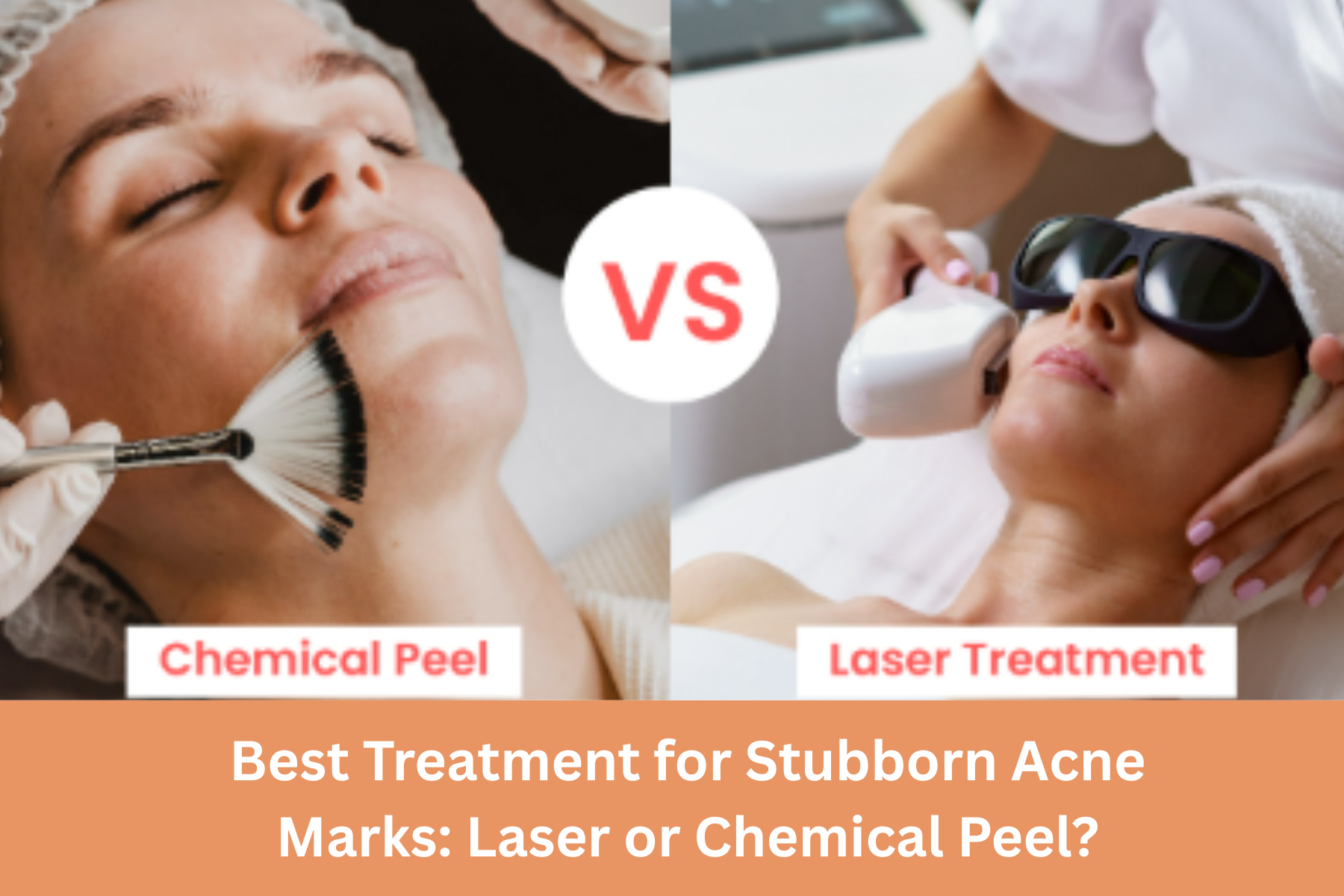 laser hair treatment in Delhi